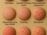 Сыпь у детей.