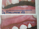 Зубы под наркозом 2
