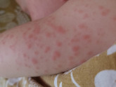 Может ли быть аллергия на укусы насекомых?