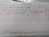 КТГ опять плохое