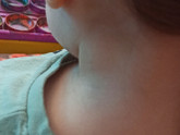 Лимфоузел на шее у ребенка