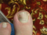 Тёмное пятно на ногте большого пальца ноги