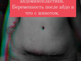 Готова поделиться всеми фото. Как закончилась беременность после абдоминопластики