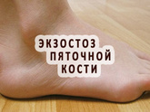 Экзостоз пяточной кости