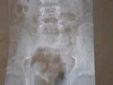 Spina bifida