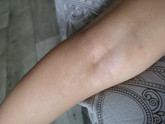 Аллергия или кожное заболевания