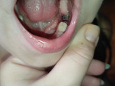 Лунка после удаления зуба