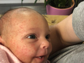 Диатез у грудничка , нам 1 месяц и 10 дней