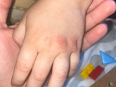 У ребенка пятно красное на руке 4 месяца , не проходит