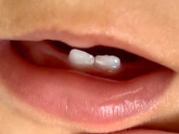 Белые полоски на молочных зубах.