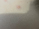 Подскажите у кого дети болели ветрянкой, как точно выглядит эта сыпь