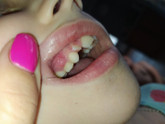 Детские зубы У ребенка