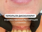 Девочки, кто ставил виниры