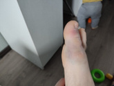 Перелом?