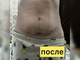 После операции диастаза прямых