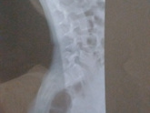 Spina bifida