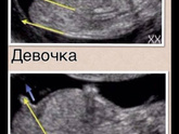 С какой вероятностью определяют пол на первом скрининге?