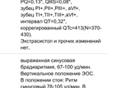 Экг