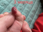 Гемангиома на пальчике
