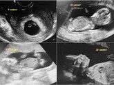 Динамика УЗИ во вторую беременность + фото)