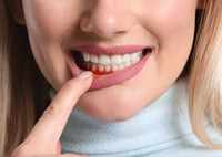Гингивит у взрослых и детей: как сохранить здоровье зубов и дёсен