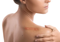 Как избавиться от шрамов: методы удаления рубцов