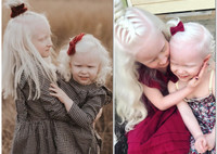 Крайне редкий случай: в семье родились сразу две девочки-альбиноса