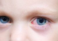 Аллергический конъюнктивит у детей – признаки, методы лечения и осложнения