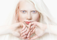 Альбинизм: красота или болезнь?