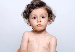 Розеола у детей: таинственная болезнь раннего возраста