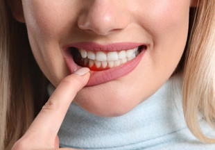 Гингивит у взрослых и детей: как сохранить здоровье зубов и дёсен