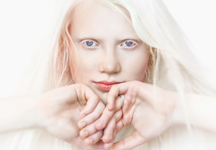 Альбинизм: красота или болезнь?