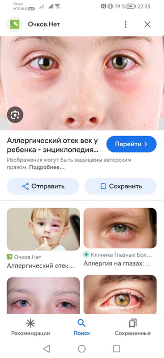 Аллергия у ребёнка!