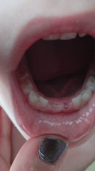 Мне кажется, или это зуб растет вертикально?