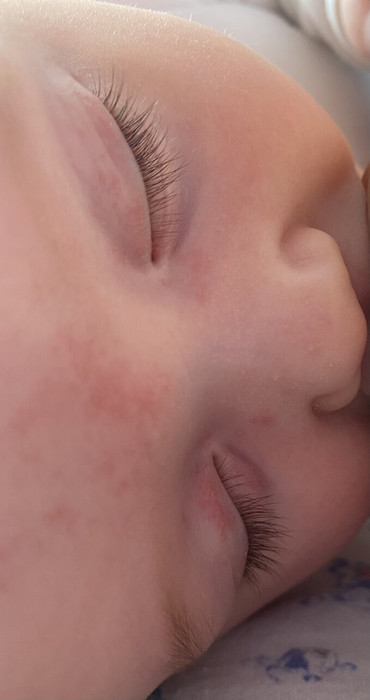 Сыпь вокруг глаз у ребёнка