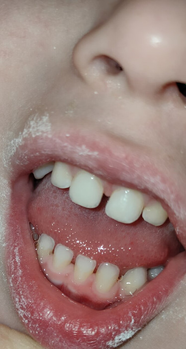 потемнение на зубах после короны