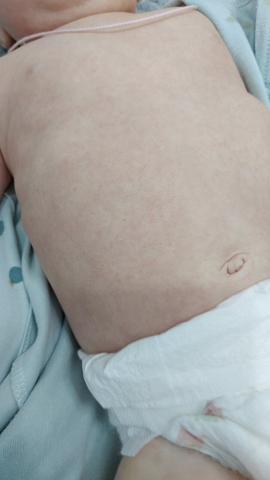 Аллергия у 3х месячной дочери на ГВ