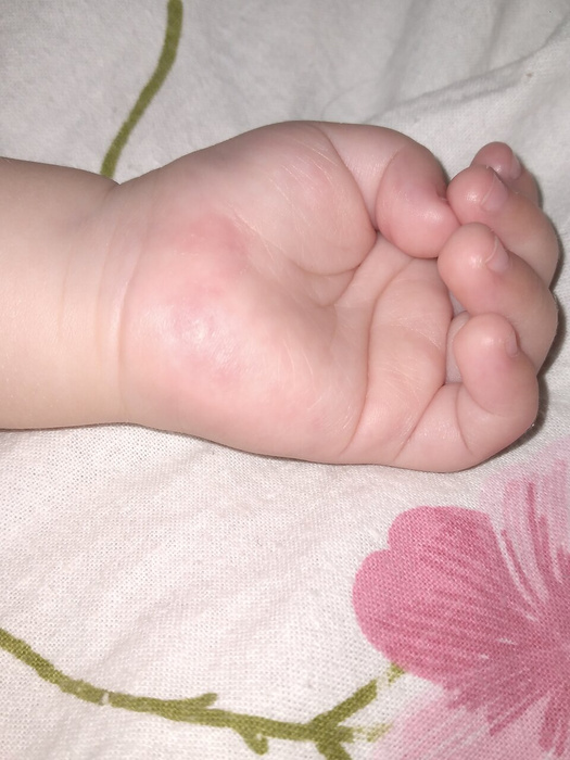 У ребёнка на ладошках