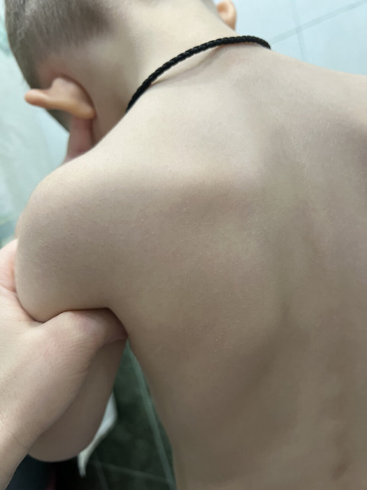 Высыпания на плечах аллергия или нет