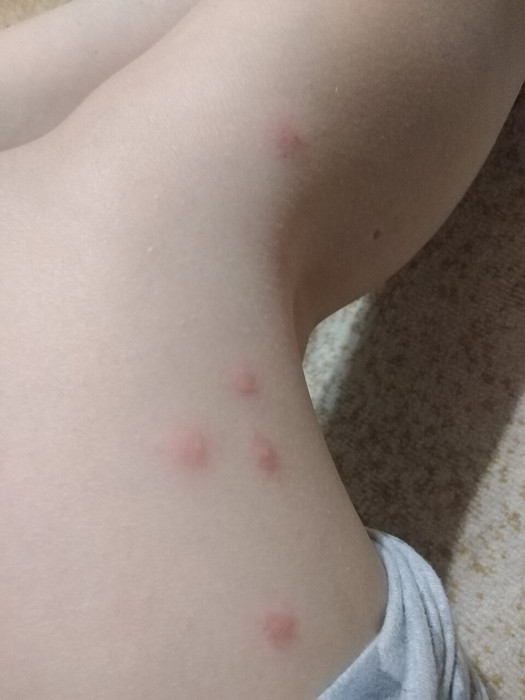 Это укусы или аллергия?