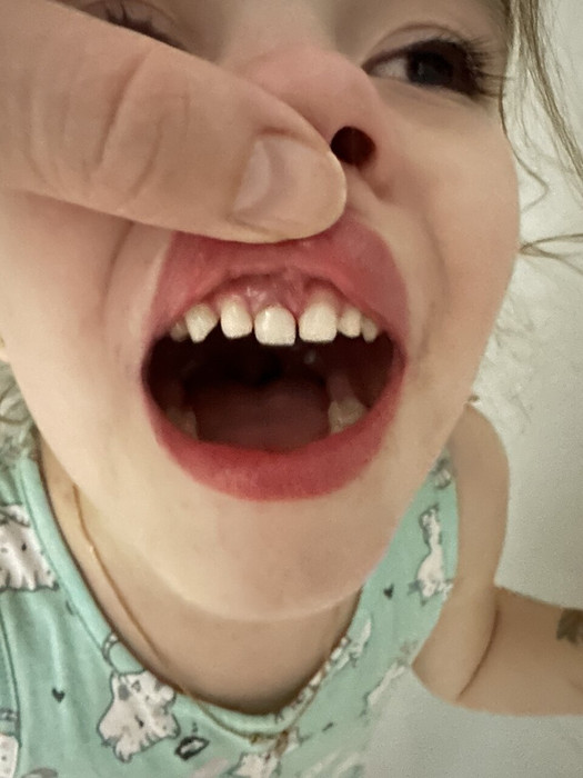 Дочь ударилась зубом