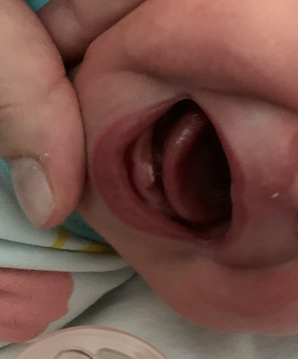 Зубы новорожденного