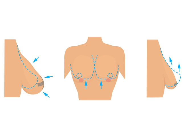 Вернуть молочным железам изначальную форму поможет подтяжка груди – мастопексия.