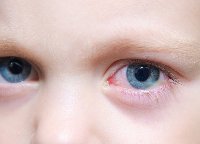 аллергический конъюнктивит у детей покраснение глаз