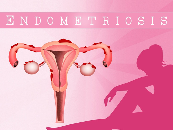 Что такое эндометриоз и чем он опасен при беременности