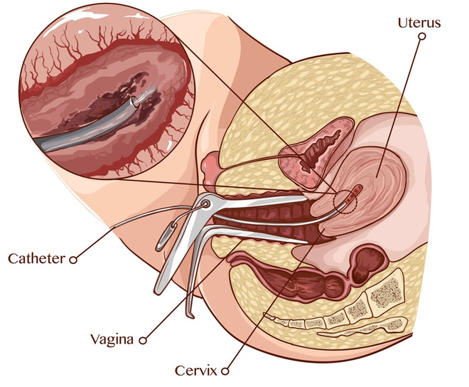 Противопоказания для пайпель-биопсии эндометрия