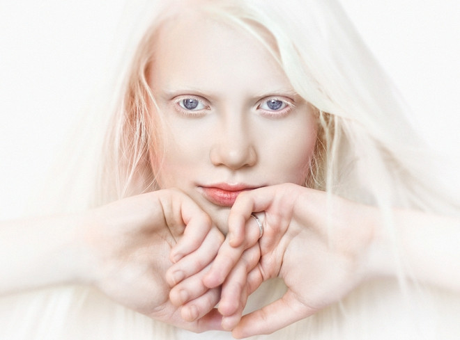признаки альбинизма