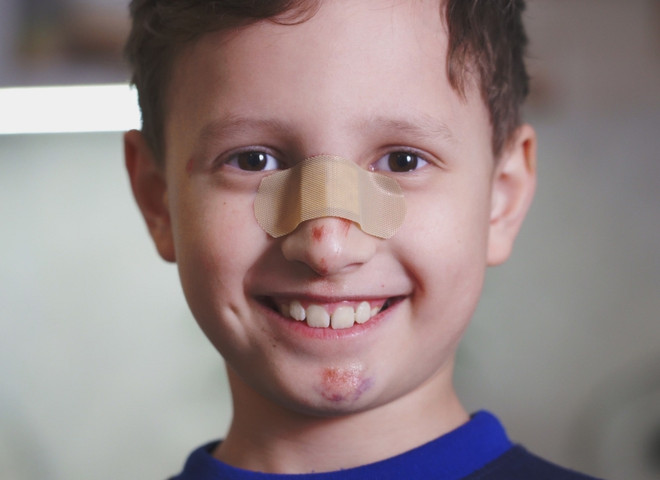 Перелом носа у ребенка: первая помощь и лечение