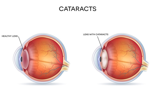 Увидеть вещи по-новому: как катаракта проявляется во взрослом возрасте и как ее лечить