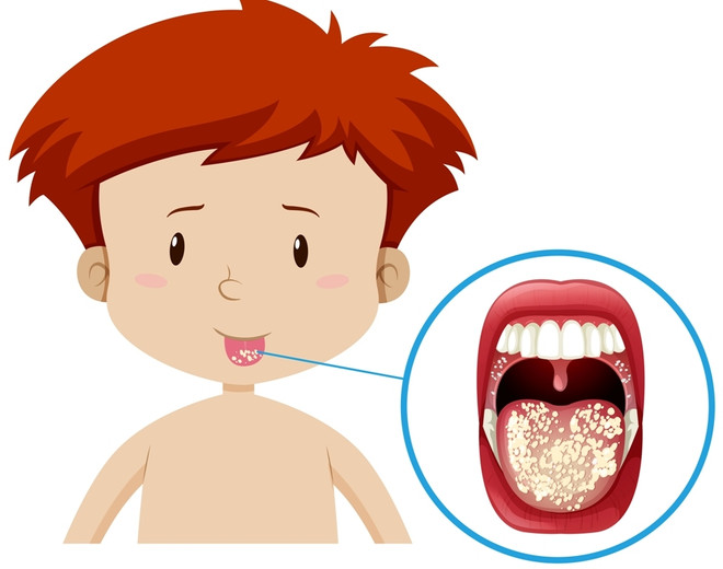 Симптомы молочницы у ребенка во рту